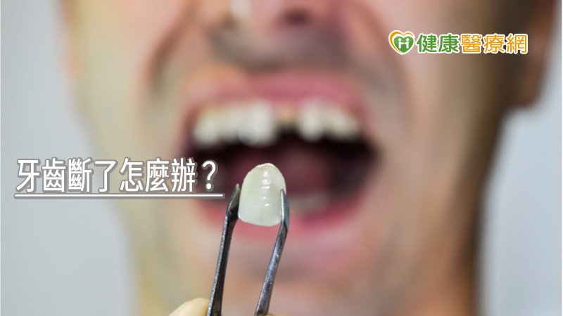 牙齒斷了怎麼辦？　專業醫師解析不同情況治療方式