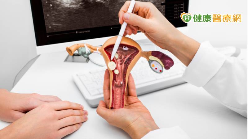 子宮肌瘤合併卵巢瘤　「單孔腹腔鏡微創手術」解困擾