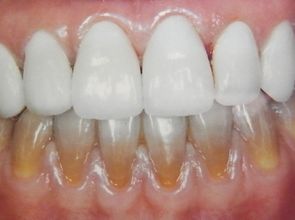牙齿黄入牙本质 陶瓷贴片改善颜色